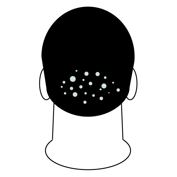 micro scalp