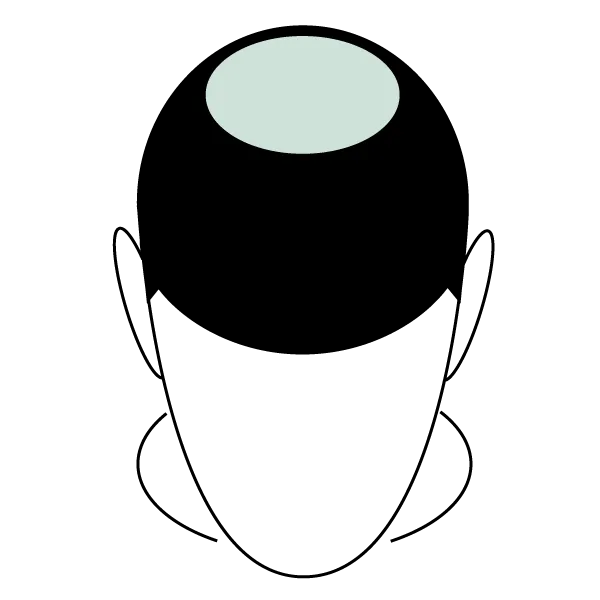 micro scalp